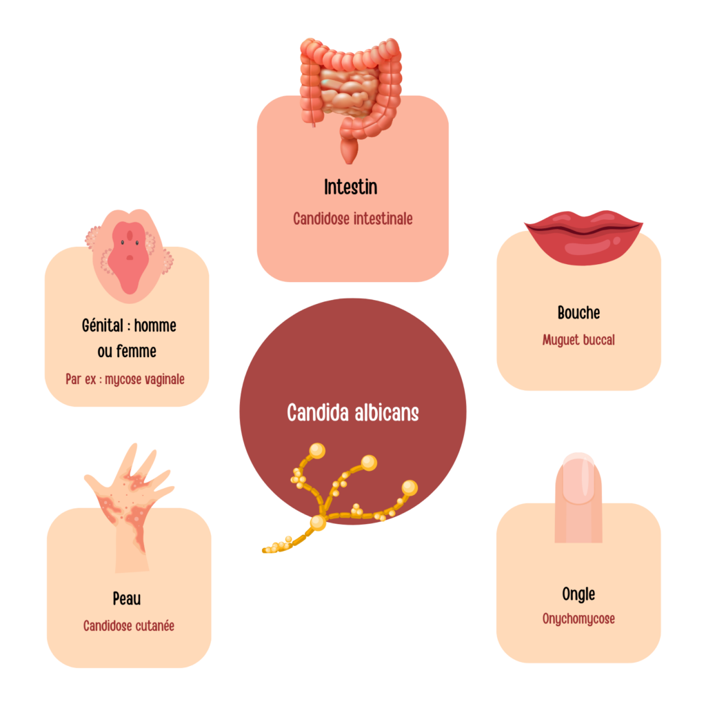 La candidose intestinale : souvent oubliée